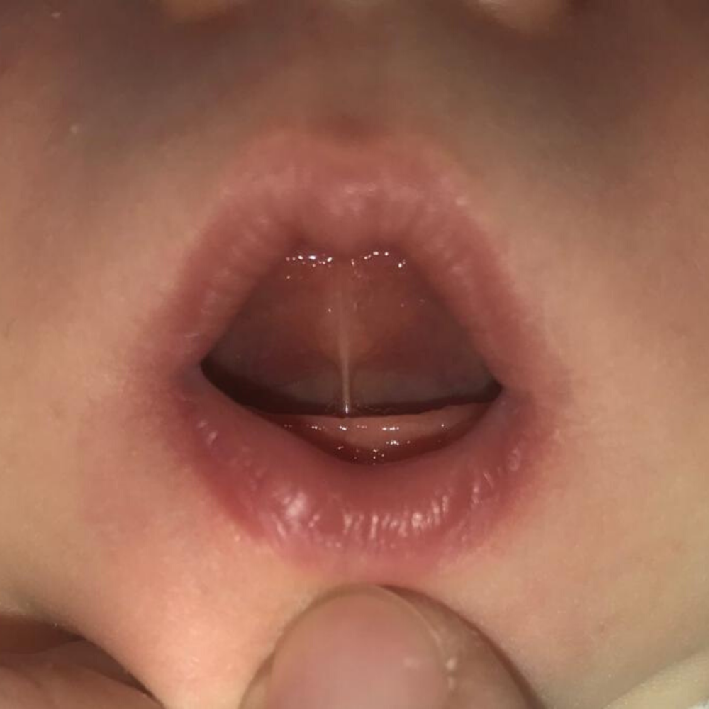 Feeding with a tongue tie Feed Eat Speak Stacey Zimmels